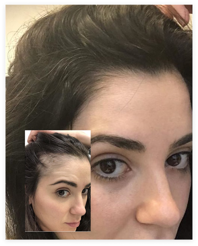 My Hair Is Filling In